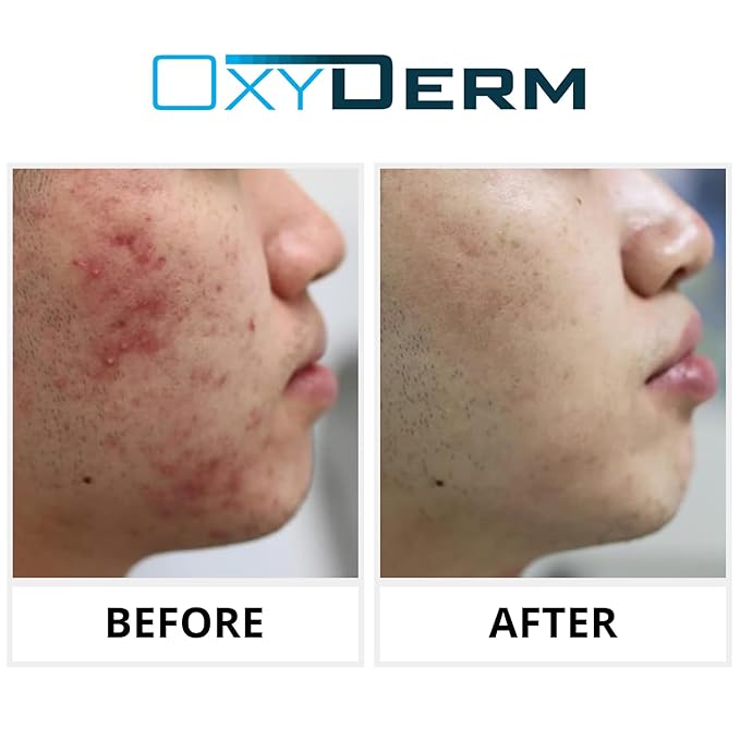 Acne Treatment Pads- Eliminates Pimple, Whitehead, blackhead, & Cystic Breakouts. Clear Clogged
