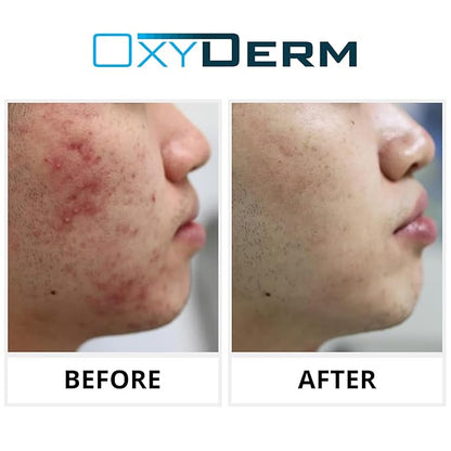 Acne Treatment Pads- Eliminates Pimple, Whitehead, blackhead, & Cystic Breakouts. Clear Clogged