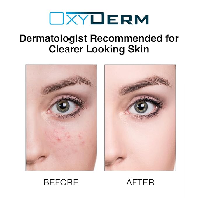Acne Treatment Pads- Eliminates Pimple, Whitehead, blackhead, & Cystic Breakouts. Clear Clogged