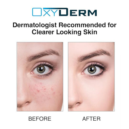 Acne Treatment Pads- Eliminates Pimple, Whitehead, blackhead, & Cystic Breakouts. Clear Clogged