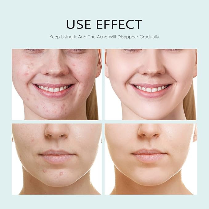 Facial Mask Anti Acne Face Masks Skin Care, Sheet Masks With Salicylic Acid Sheet For Acne Prone
