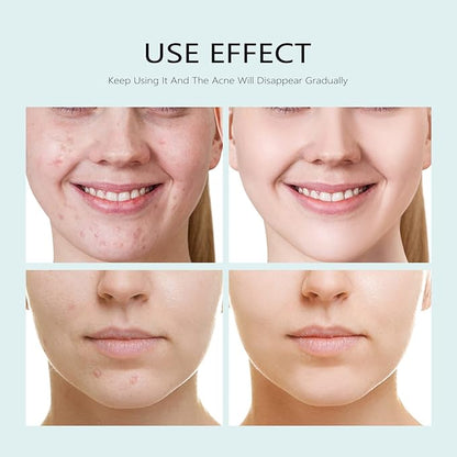 Facial Mask Anti Acne Face Masks Skin Care, Sheet Masks With Salicylic Acid Sheet For Acne Prone
