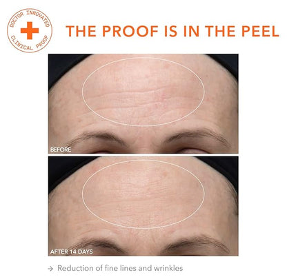 Dr. Dennis Gross Alpha Beta Ultra Gentle Daily Peel: for Dehydrated or Sensitive Skin, Uneven Tone