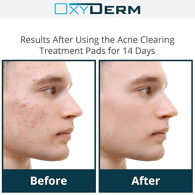 Acne Treatment Pads- Eliminates Pimple, Whitehead, blackhead, & Cystic Breakouts. Clear Clogged