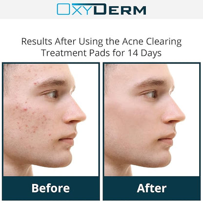 Acne Treatment Pads- Eliminates Pimple, Whitehead, blackhead, & Cystic Breakouts. Clear Clogged