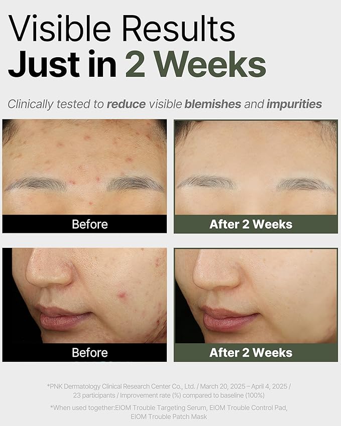 Trouble Patch Mask | Korean Face Mask ??Hydrating & Acne Face Mask for Blemish-Prone Skin, Calming