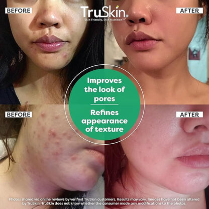 TruSkin Tea Tree Oil Acne Treatment for Face – Acne Serum – Improve the Appearance of Pores, Skin